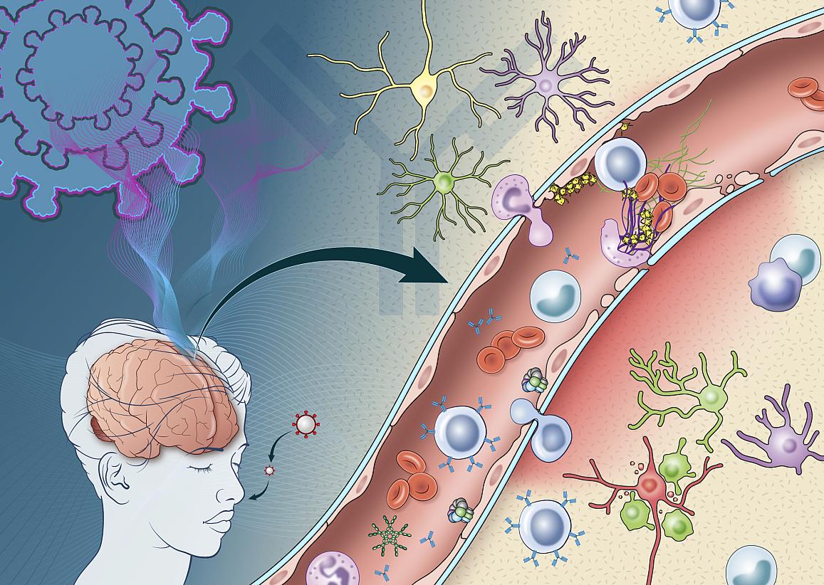 SARS-CoV-2 infection can damage cells lining blood vessels in the brain