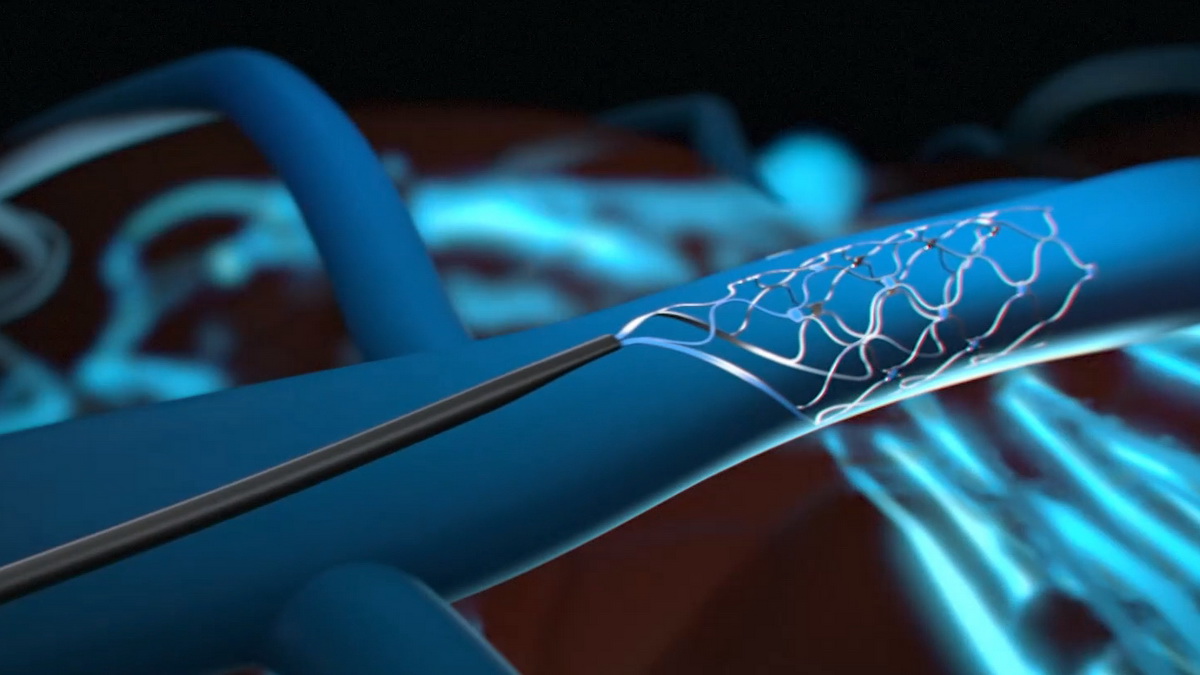 Synchron: The First Chip Implanted Into a Human Brain