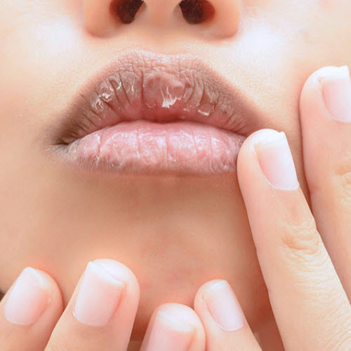 How to Avoid Chapped Lips This Winter, According to Dermatologists